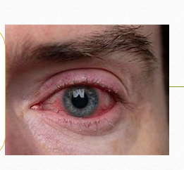 Penyakit mata konjungtivitis