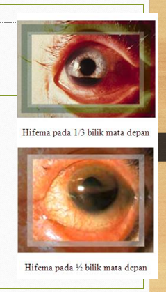 Penyakit Hifema Pada Mata - penyakit pada bilik mata depan