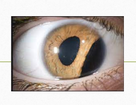 Contoh penyakit mata Iridodialisis