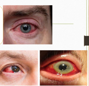 Penyakit Mata Konjungtivitis