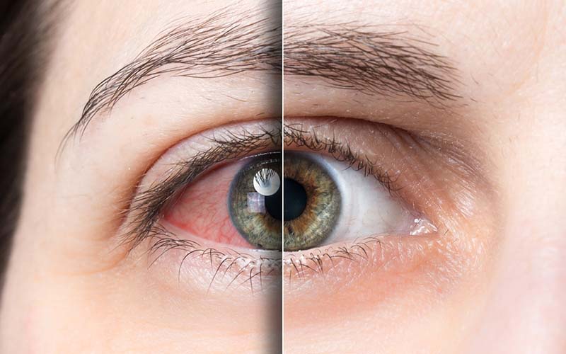 Sindrom Mata Kering: Penyebab, Gejala, Cara Mengobati