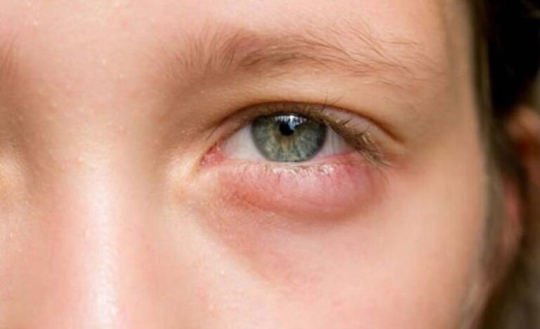 Penyebab Mata Bengkak Dan Cara Mengatasinya