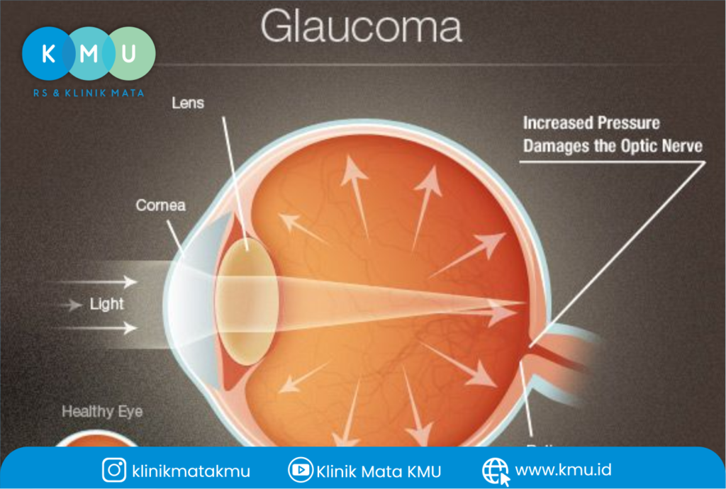 Glaukoma sudut tertutup
