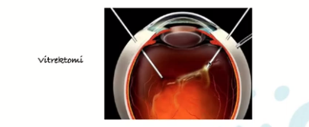 Vitrektomi Jenis Operasi Retina