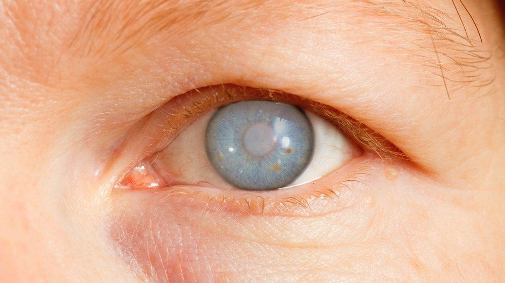 Glaukoma Sudut Tertutup (penerita Glaukoma wajib periksa mata)