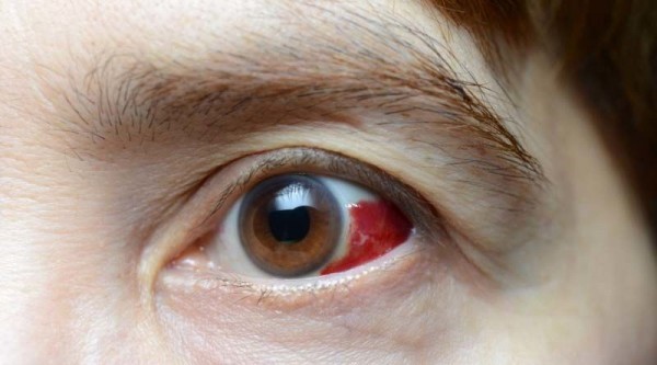 penyebab mata berdarah dan cara mengatasinya