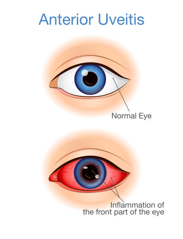 penyakit pada iris mata