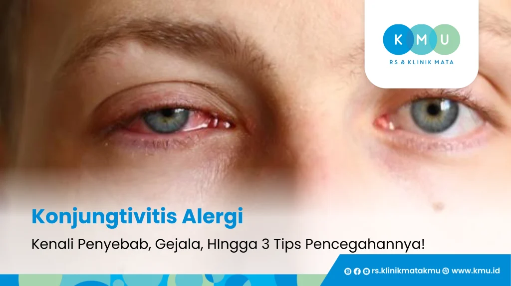 Konjungtivitis Alergi - Kenali Penyebab, Gejala, HIngga 3 Tips Pencegahannya