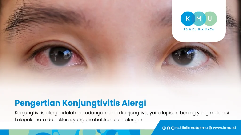 Pengertian Konjungtivitis Alergi