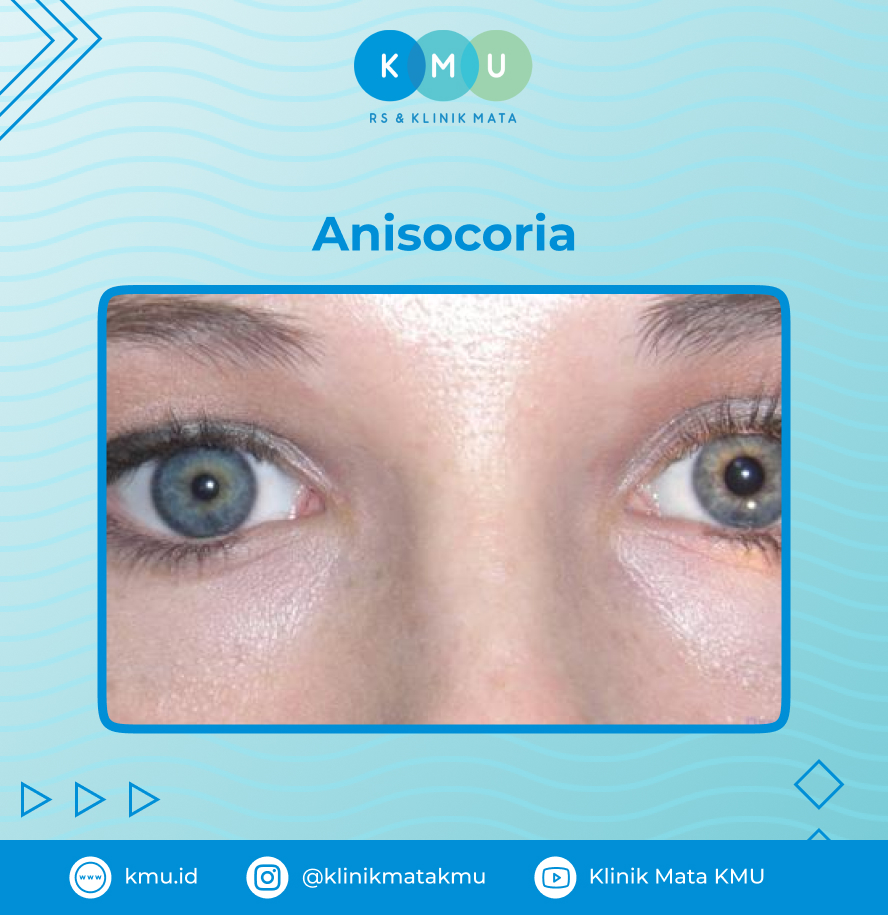 Anisocoria -Pupil Mata