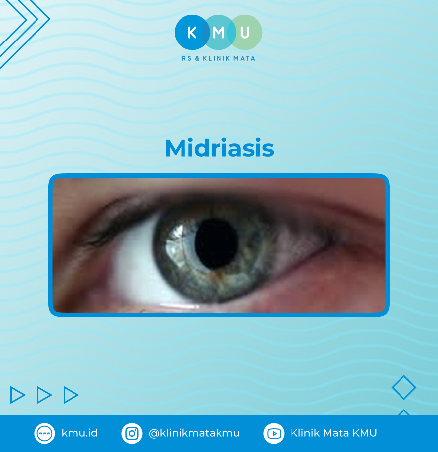 Midriasis - Pupil Mata