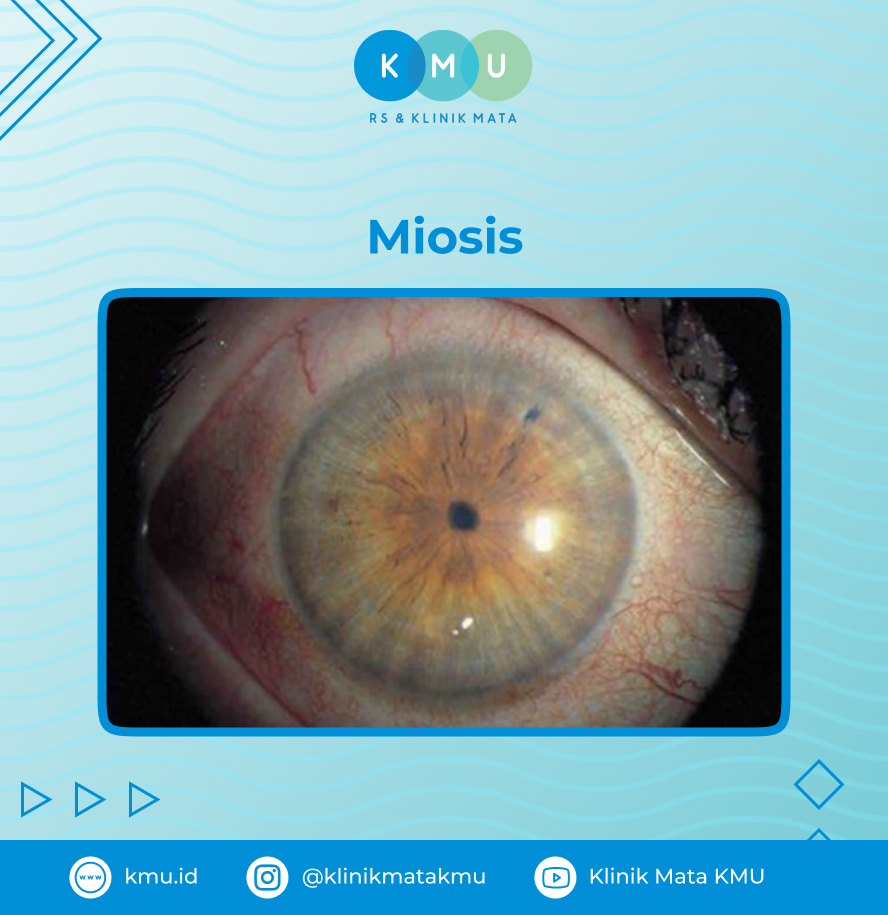 Miosis - Pupil Mata