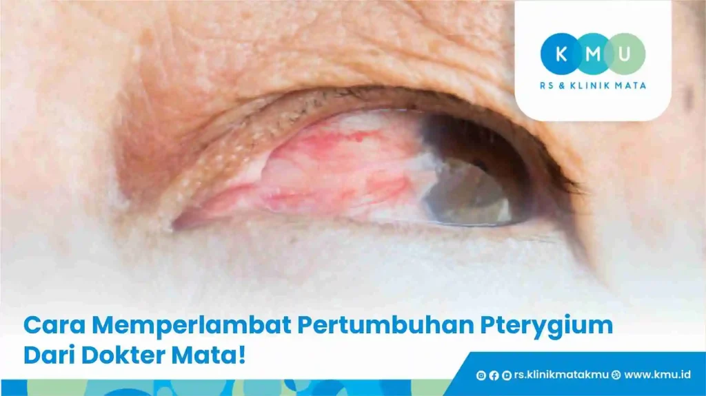 Cara Memperlambat Pertumbuhan Pterygium Dari Dokter Mata!
