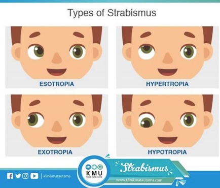 strabismus (mata juling)