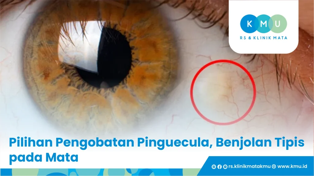 pinguecula