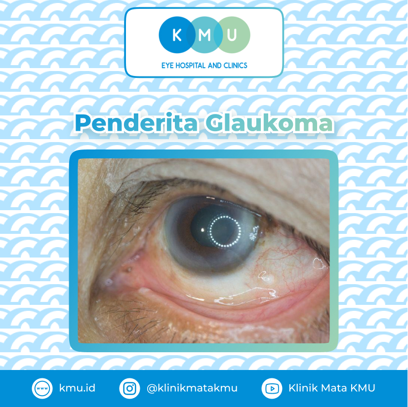 Penglihatan Orang Dengan Penyakit Mata Glaukoma