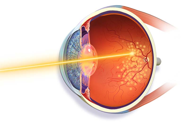 biaya laser retina (PRP)