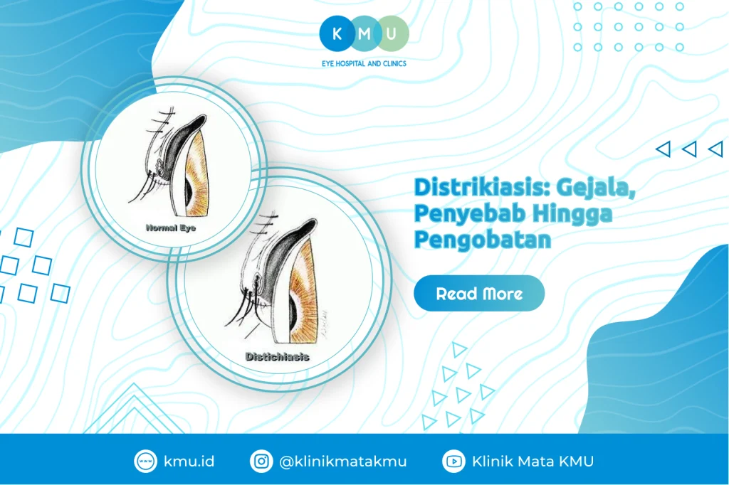 Distrikiasis, Gejala, Penyebab Hingga Pengobatan