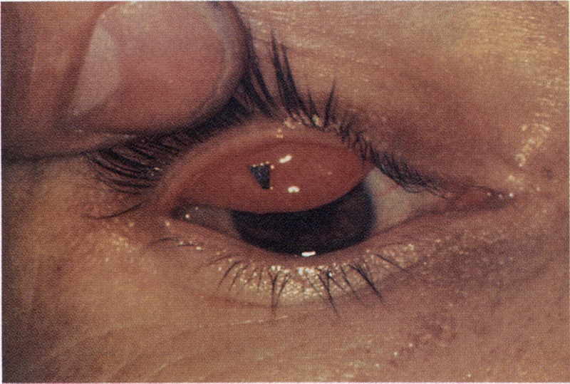 penanganan awal trauma kimia mata