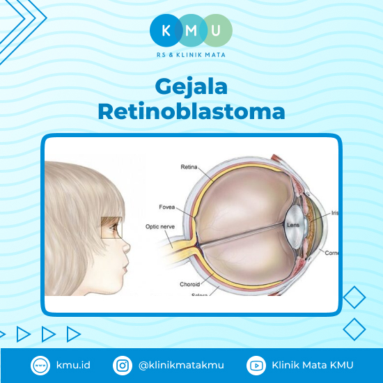 Gejala Retinoblastoma