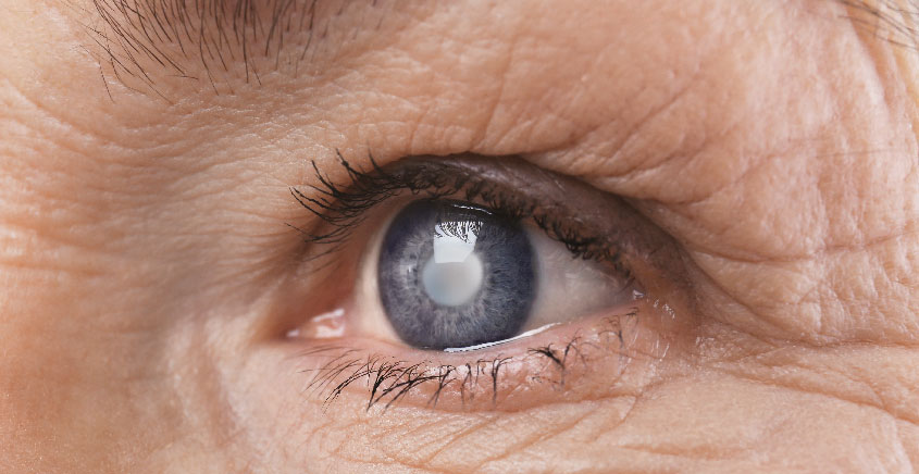 katarak menghambat fungsi mata