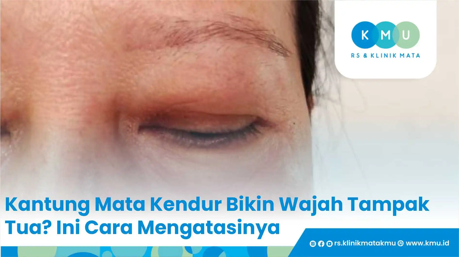 Kantung Mata Kendur Bikin Wajah Tampak Tua? Ini Cara Mengatasinya
