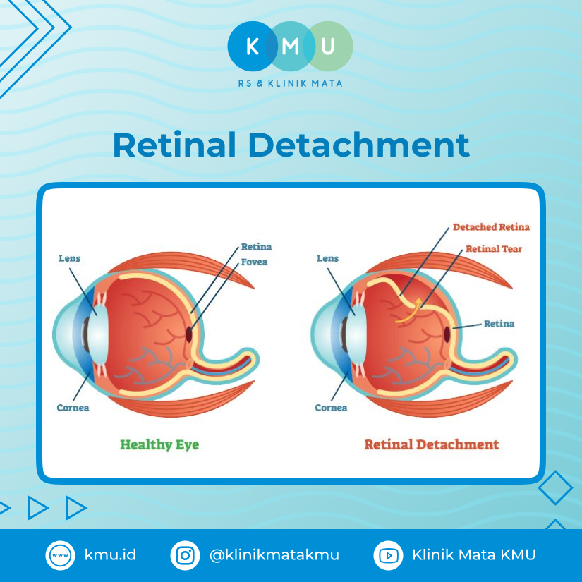 Retina Detachment