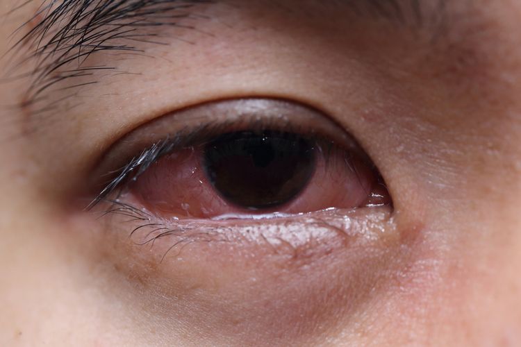 Kondisi mata berlendir yang dapat mengganggu penglihatan