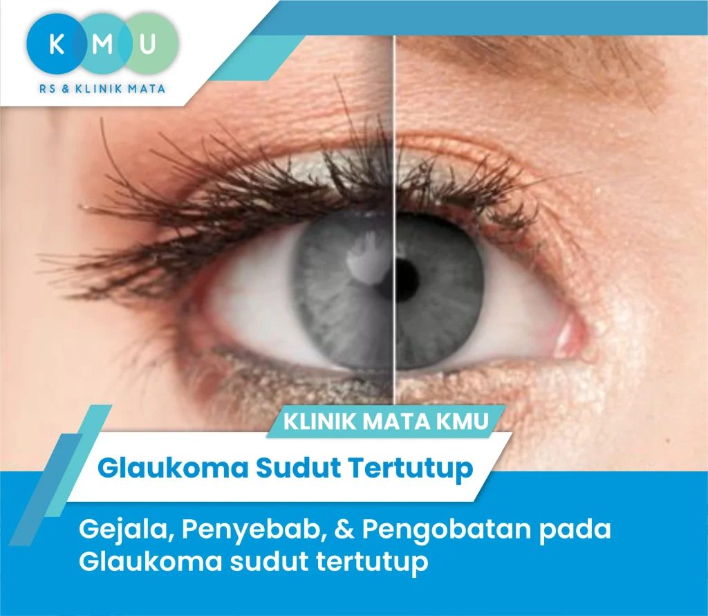 Glaukoma
