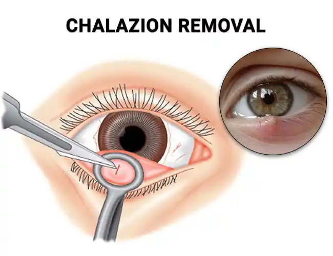 Pengobatan Kalazion