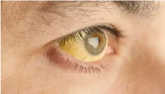 Mata Berwarna Kuning? Hati-Hati Bisa Jadi Gejala dari 4 Penyakit Ini!