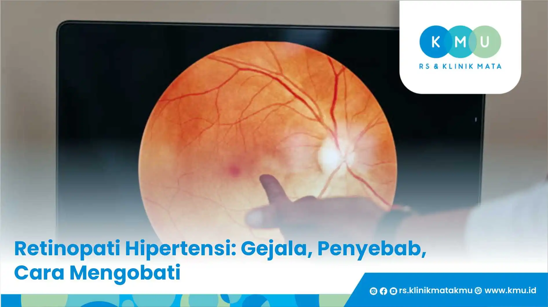 Retinopati Hipertensi: Gejala, Penyebab, Cara Mengobati
