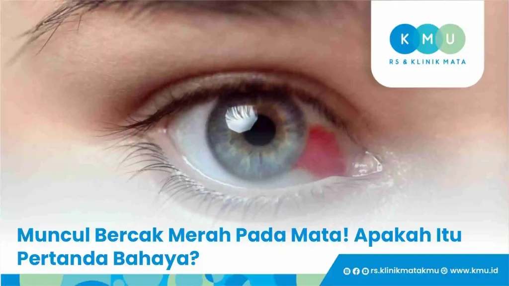 Muncul Bercak Merah Pada Mata! Apakah Itu Pertanda Bahaya?