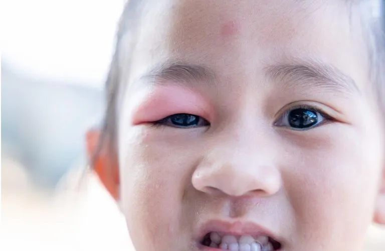 Blepharitis