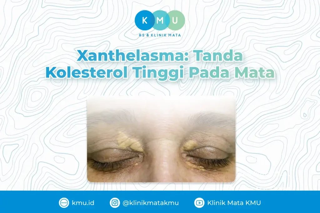 Xanthelasma: Tanda Kolesterol Tinggi Pada Mata
