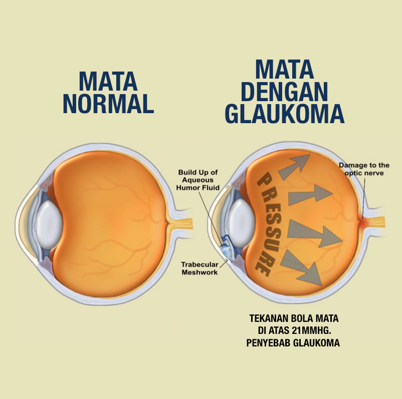 mata normal vs glaukoma