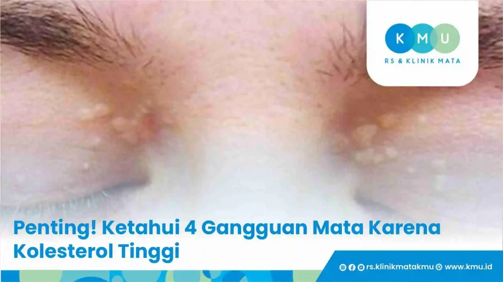 Penting! Ketahui 4 Gangguan Mata Karena Kolesterol Tinggi