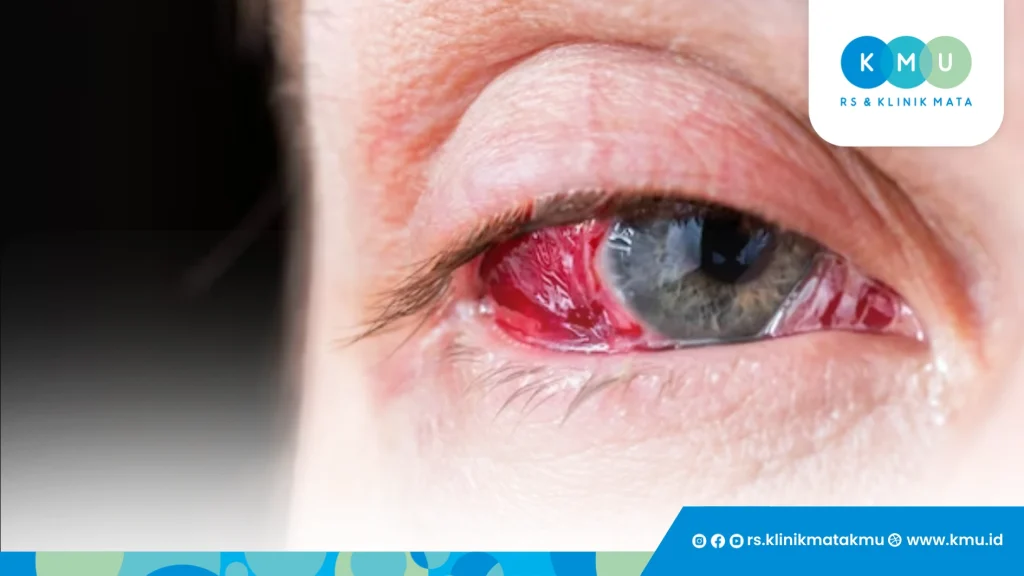 Waspadai Penyebab Pembuluh Darah Mata Pecah