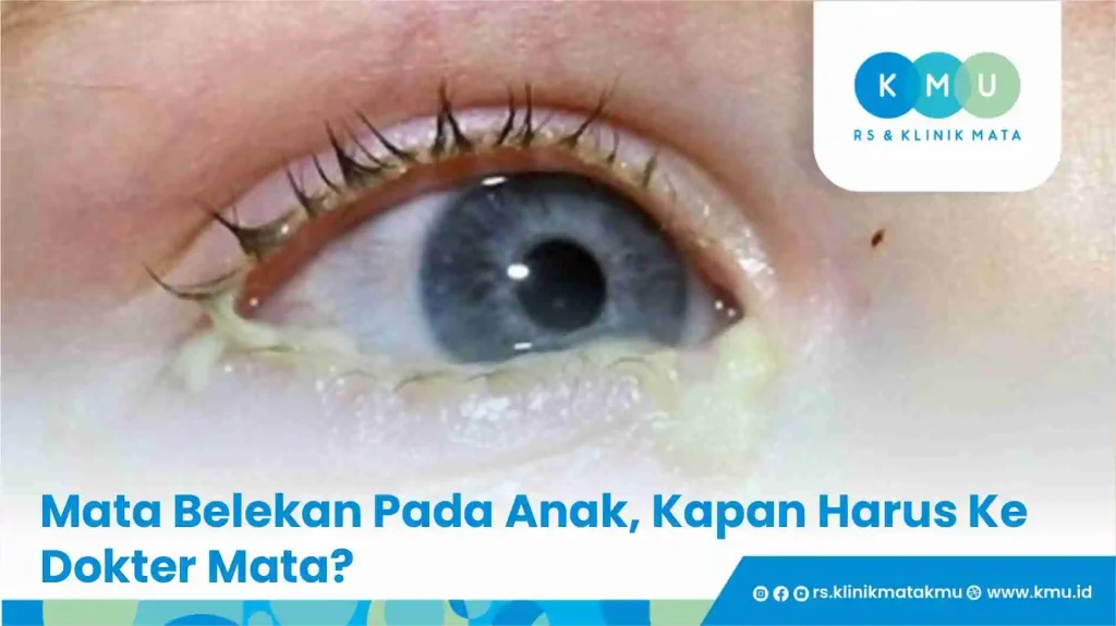 Mata Belekan Pada Anak, Kapan Harus Ke Dokter Mata?