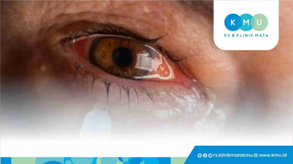 7 Cara Ampuh Mengatasi Mata Mengganjal