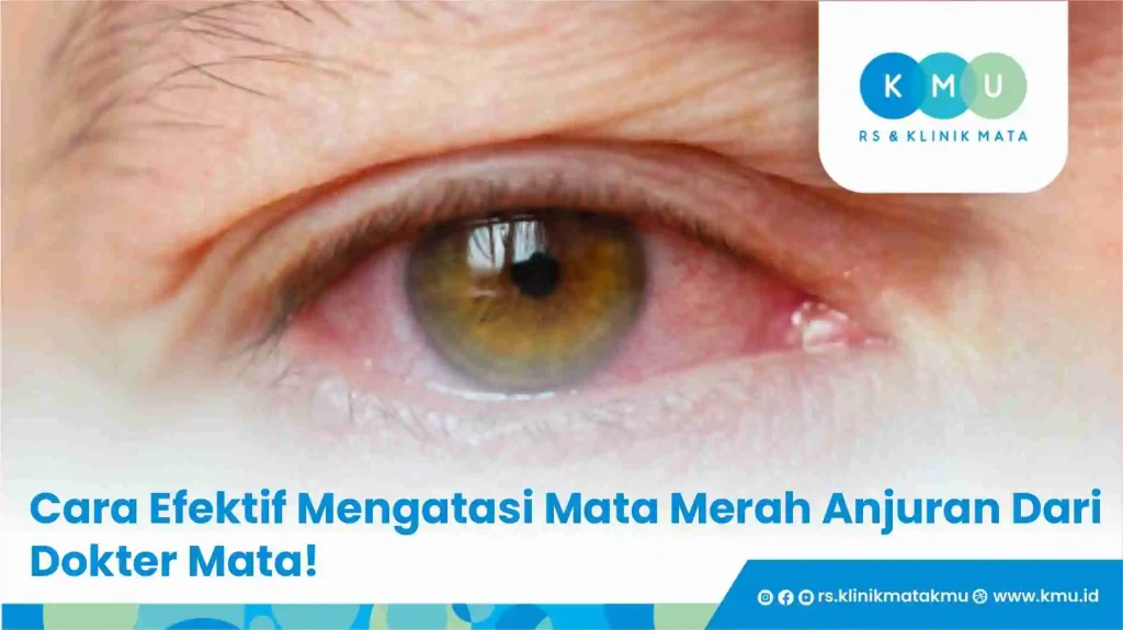 Cara Efektif Mengatasi Mata Merah Anjuran Dari Dokter Mata!