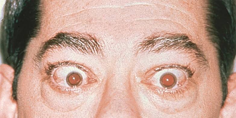 Graves Eye Disease
