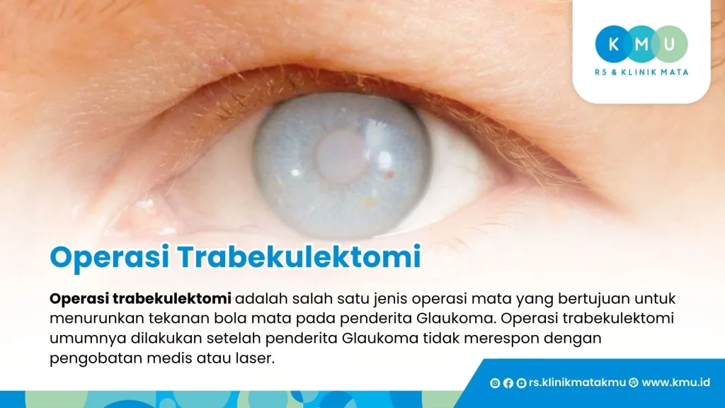Operasi Trabekulektomi
