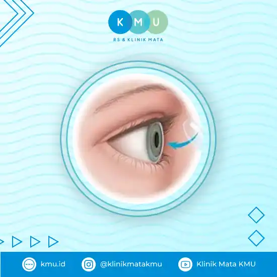 Apa Itu Cangkok Kornea & Mengapa Menyebabkan Kebutaan Akibat Kerusakan