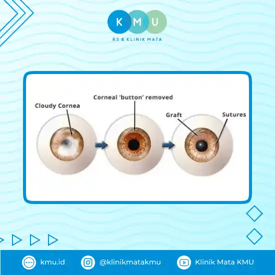 KMU Membuka Layanan Cangkok Kornea