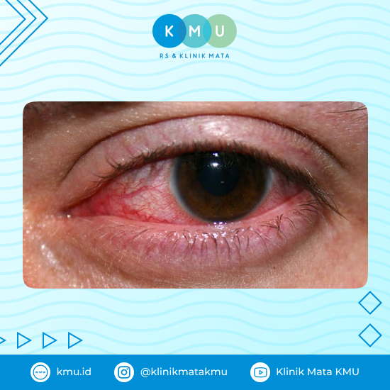 Mata merah bisa jadi salah satu tanda episkleritis.