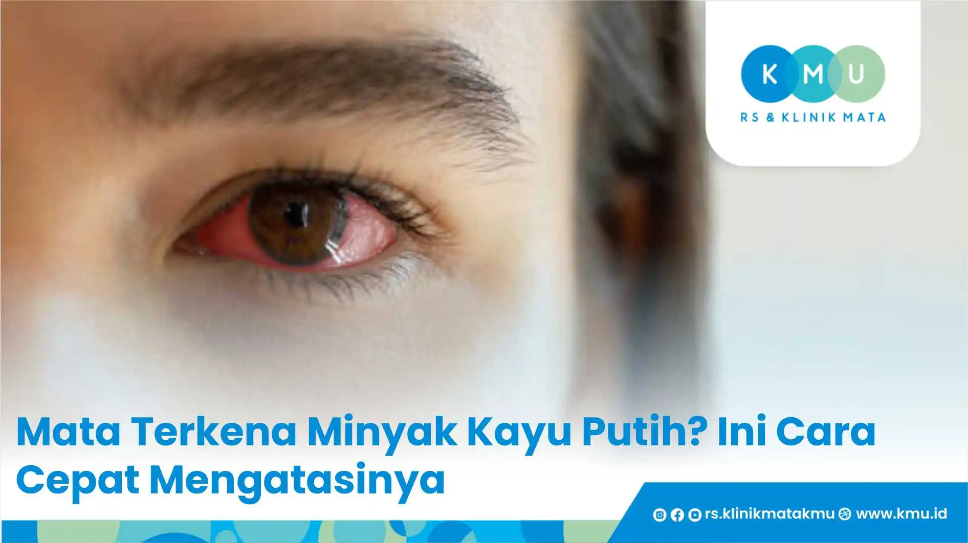 Mata Terkena Minyak Kayu Putih? Ini Cara Cepat Mengatasinya