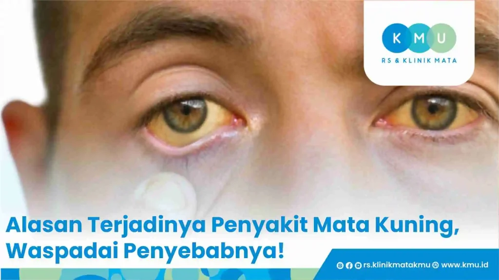 Alasan Terjadinya Penyakit Mata Kuning, Waspadai Penyebabnya?