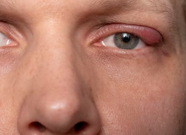 Penyebab bintitan pada mata