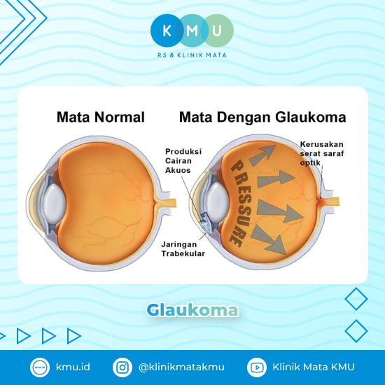 Glaukoma - Penyakit Mata pada Lansia